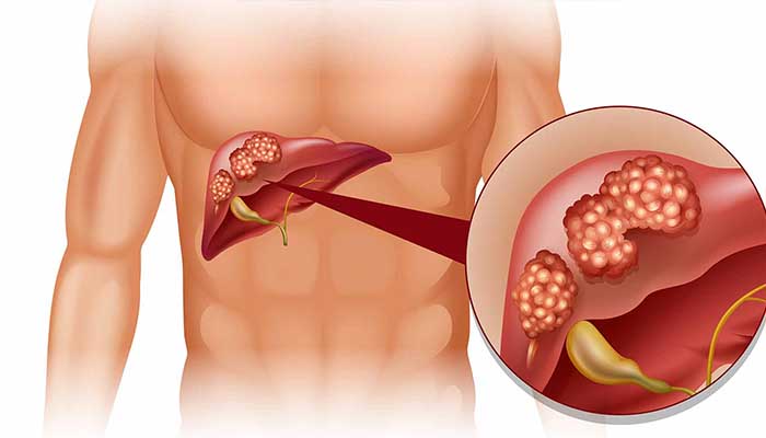 complete blood count test (CBC)